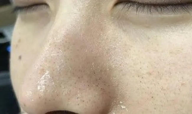 去黑头的实用方法 去黑头的实用方法视频