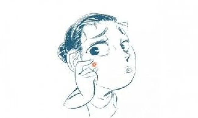 痘痘痘印怎样去除小窍门 痘痘印怎么治