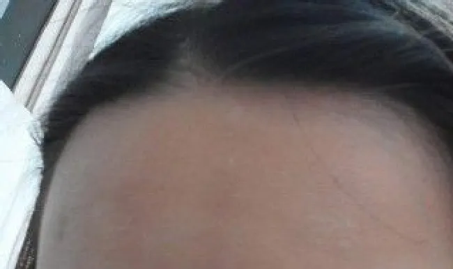 额头老是起干皮怎么办（额头老是起干皮怎么办呢）